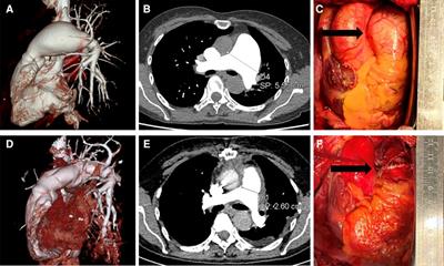 Case Report: Surgical management of idiopathic pulmonary aneurysms and review surgical approaches